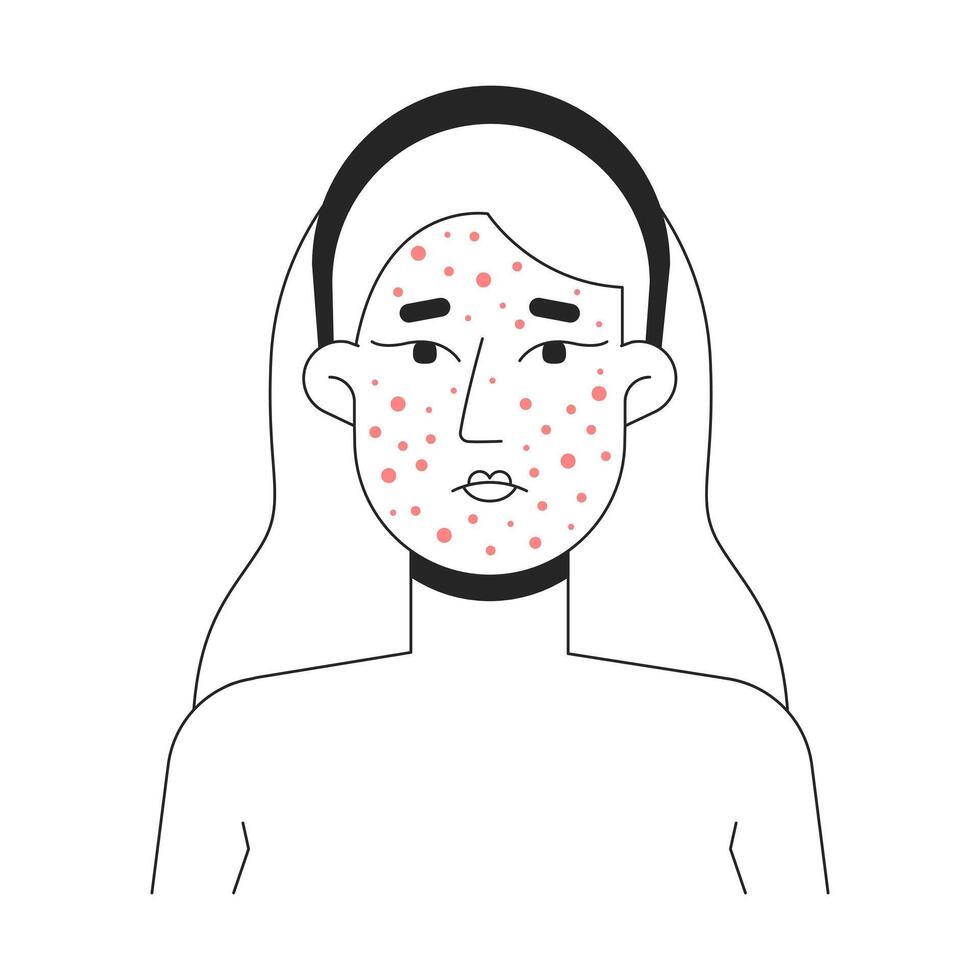 Blonde woman acne breakout skin problem outline illustration. Rosacea facial rash. Caucasian female face pimples irritation 2D line character isolated on white. Monochrome ink linear image vector
