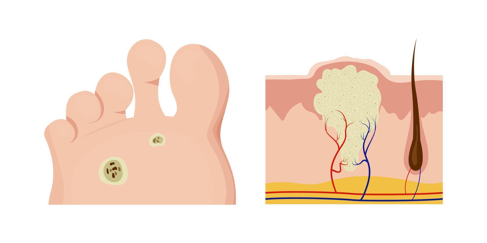 Plantar wart affecting skin layers and causing foot pain vector