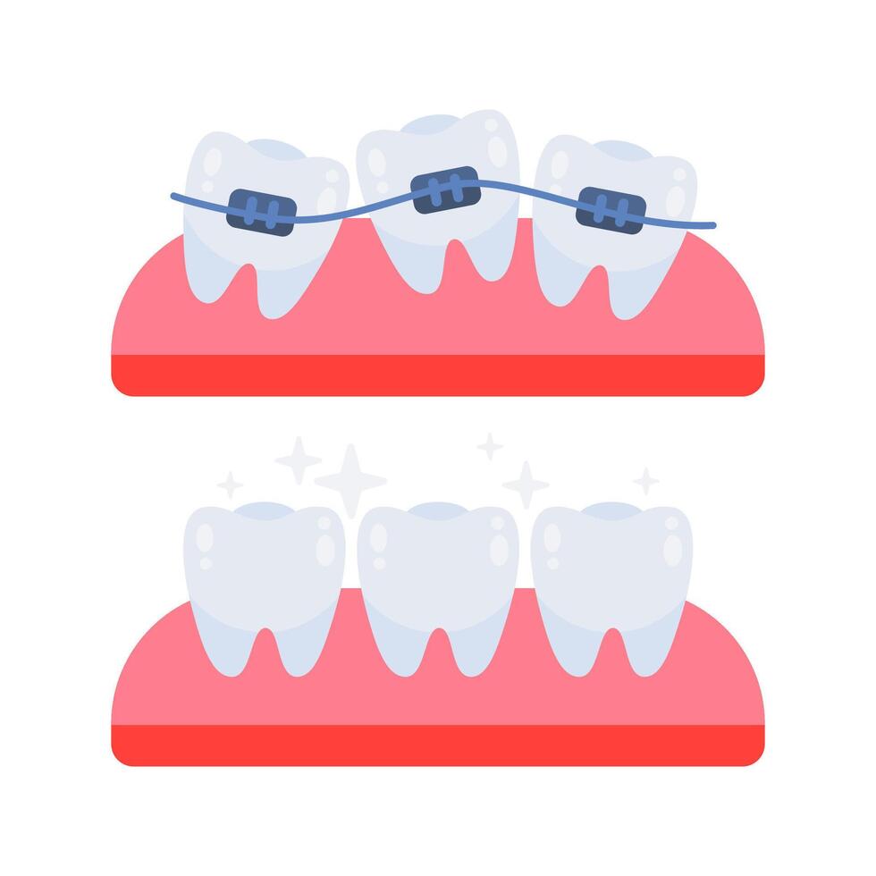 Teeth straightening with braces showing before and after stages vector