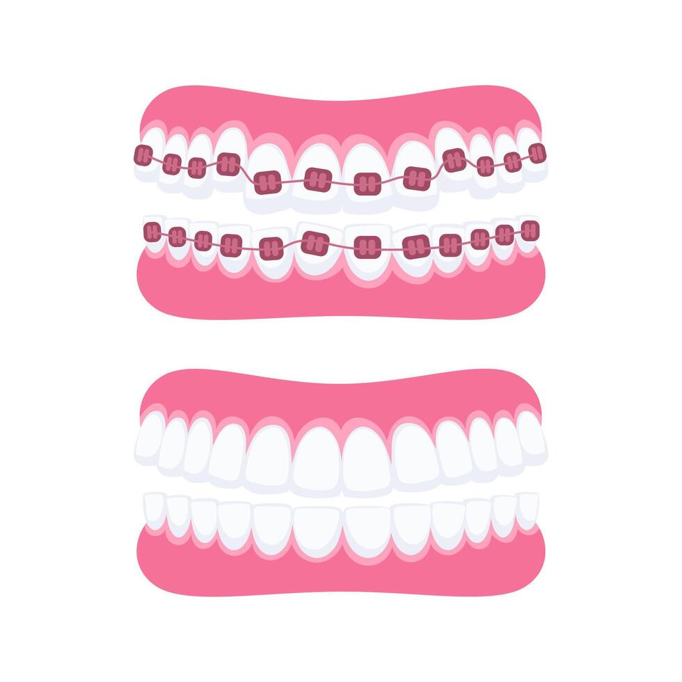 Orthodontic treatment showing teeth with and without braces vector