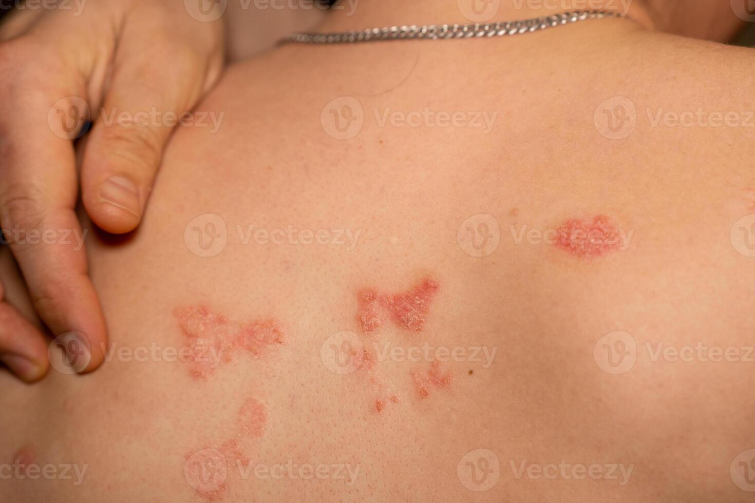 Understanding psoriasis and its effects on the skin with red, itchy patches on a persons back photo