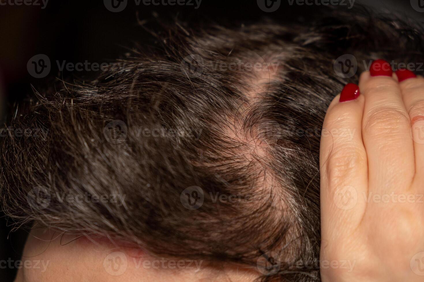 Uncovering psoriatic patches on the scalp highlighting symptoms and challenges of skin conditions photo
