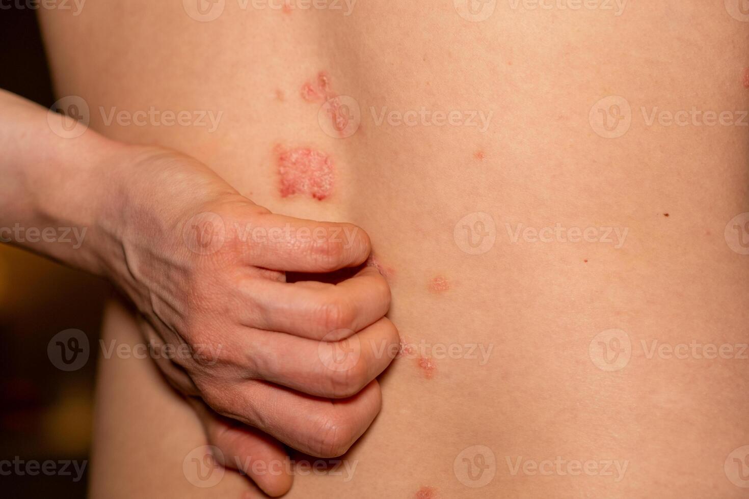 Understanding psoriasis with red itchy patches visible on the skin in a close up view of the lower back area photo