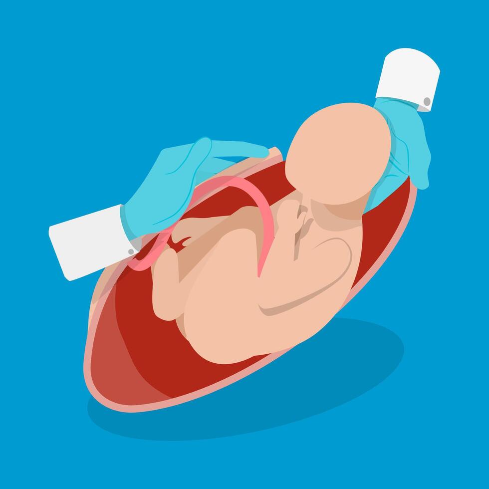 3D Isometric Flat Illustration of Cesarean Section, Medical Surgery and Abdominal Incision vector