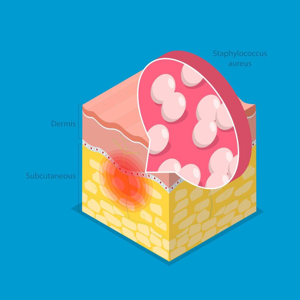 3D Isometric Flat Illustration of Cellulitis, Bacterial Infection vector