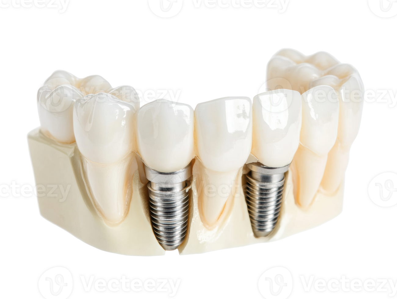 Dental implant model demonstrating oral restoration techniques png