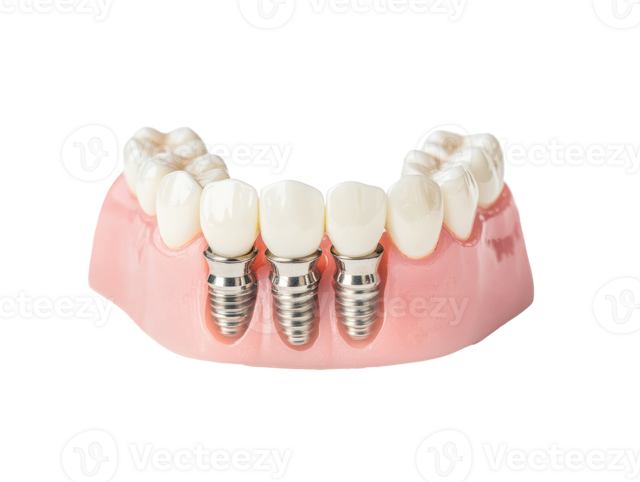 Dental implants for restoring smiles and improving oral health png