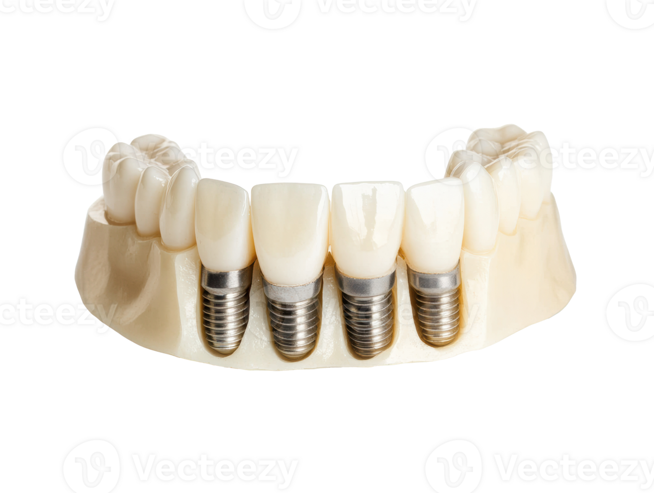 Dental implants with realistic crowns for oral rehabilitation png