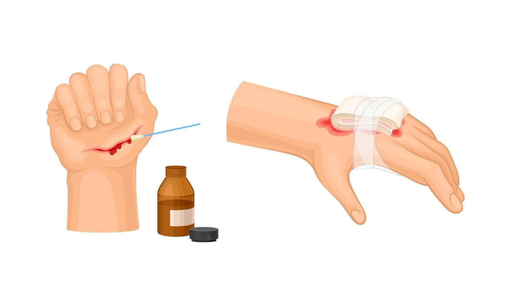 Skin burn injury treatment. Hurt human hand with first aid bandage illustration vector