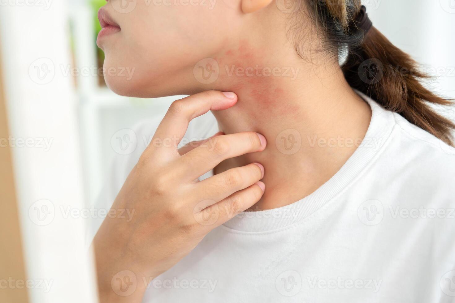 skin problem. Young woman scratch body has itchy skin from skin allergic, steroid allergy, sensitive skin, red from sunburn, chemical allergy, rash, insect bites, Seborrheic Dermatitis. photo