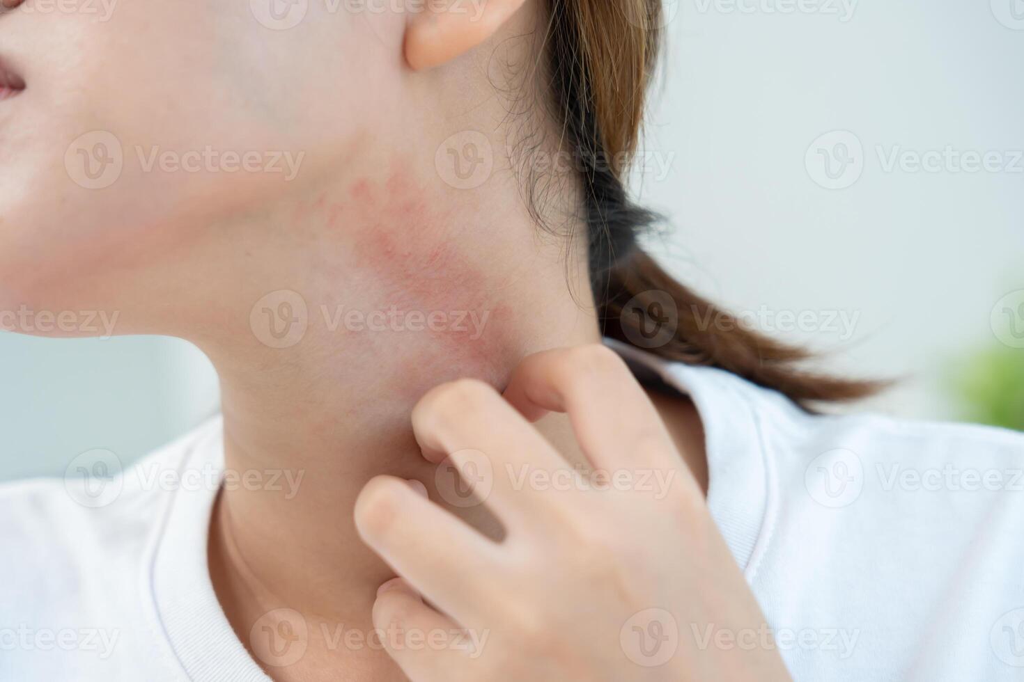 problem and beauty. Young woman scratch body has itchy skin from skin allergic, steroid allergy, sensitive skin, red from sunburn, chemical allergy, rash, insect bites, Seborrheic Dermatitis. photo