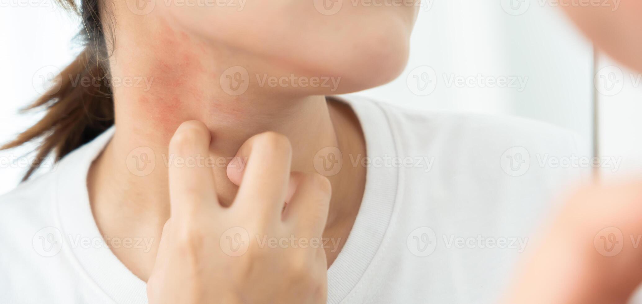 Skin and beauty problems, Women have itchy skin and red rashes from cosmetic allergies, steroid allergies, sensitive skin, redness from sunlight, chemical allergies rashes, insect bites. photo