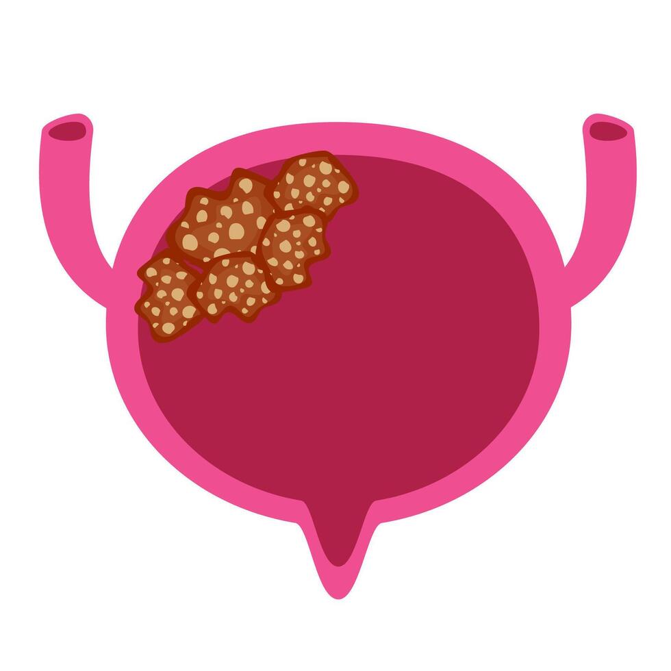 Bladder cancer. Bladder disease illustration vector