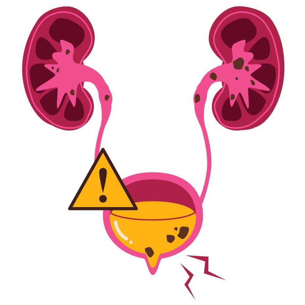 Kidney infection. Bladder stones illustration vector