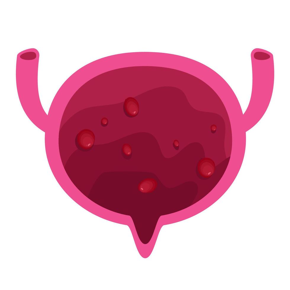 Bladder polyps illustration. Bladder disease vector