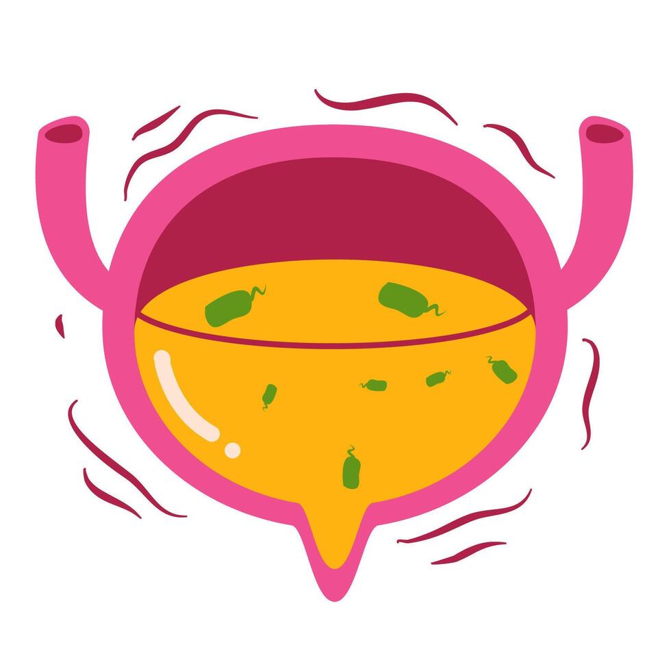 Bladder disease illustration. Urinary tract infection vector
