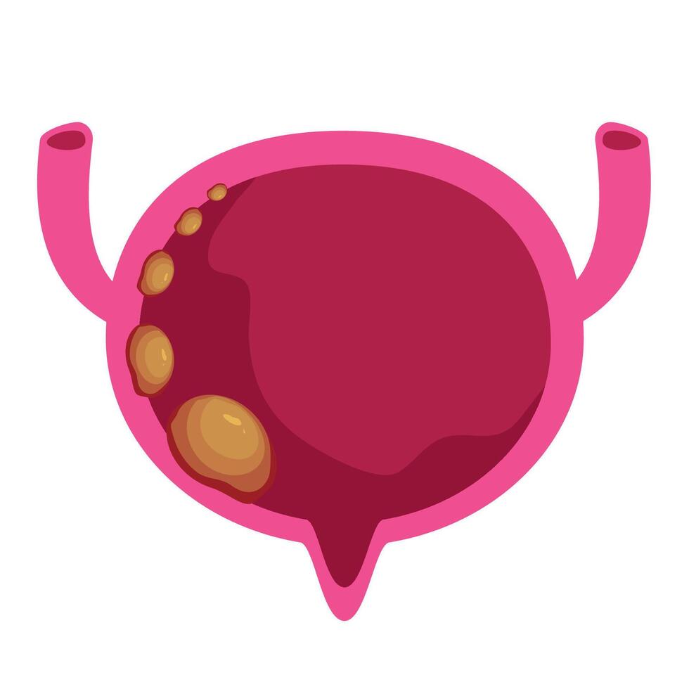 Bladder cancer. Bladder disease vector
