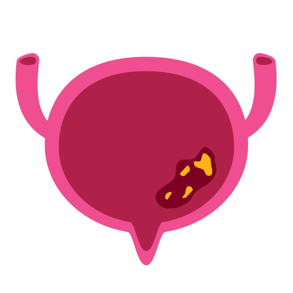 Bladder cancer illustration. Bladder disease vector