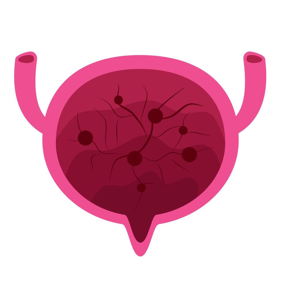 Cystitis bladder illustration. Inflammation Bladder vector