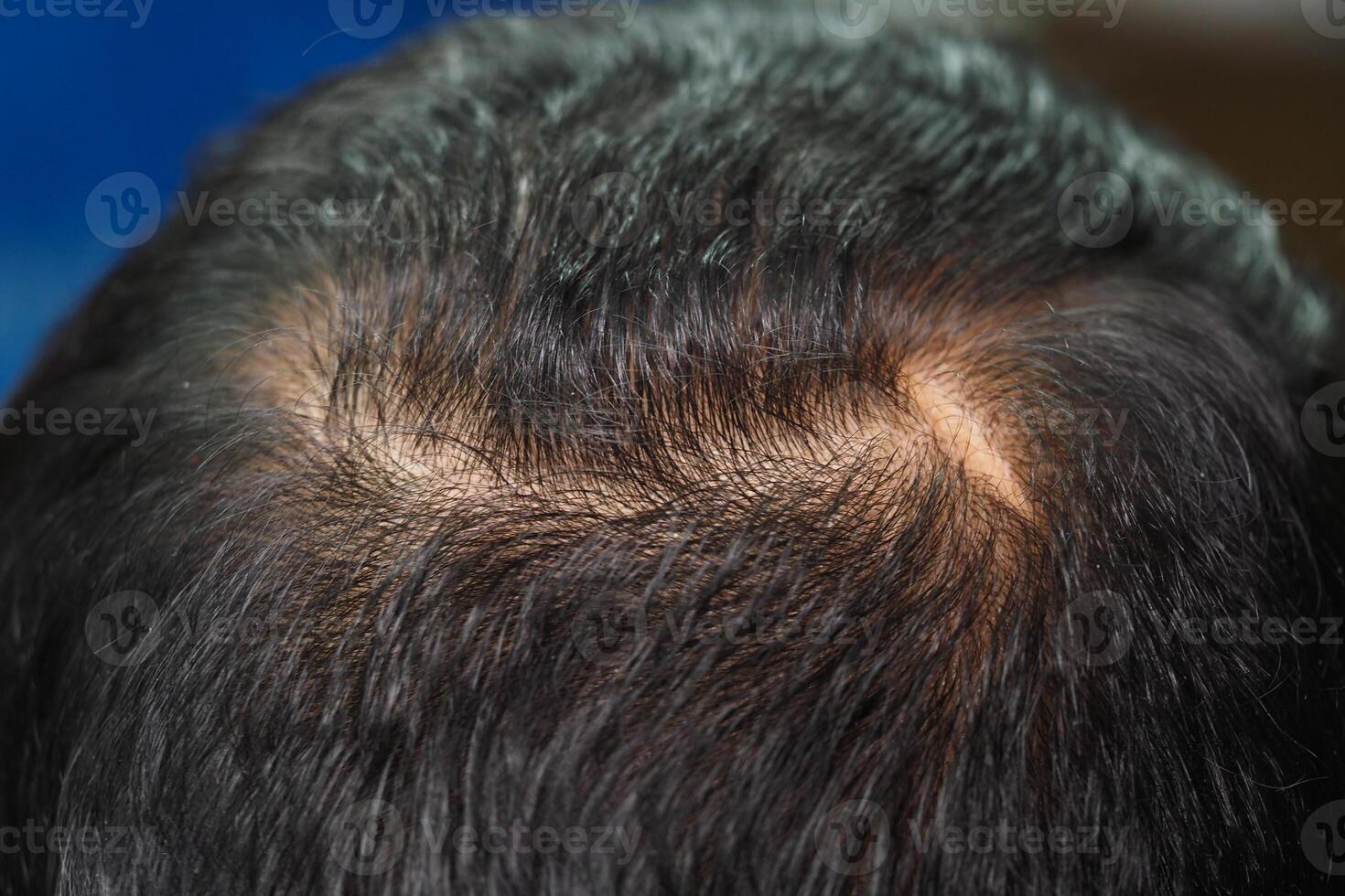 Bald spot on head showing thinning hair and light scalp photo