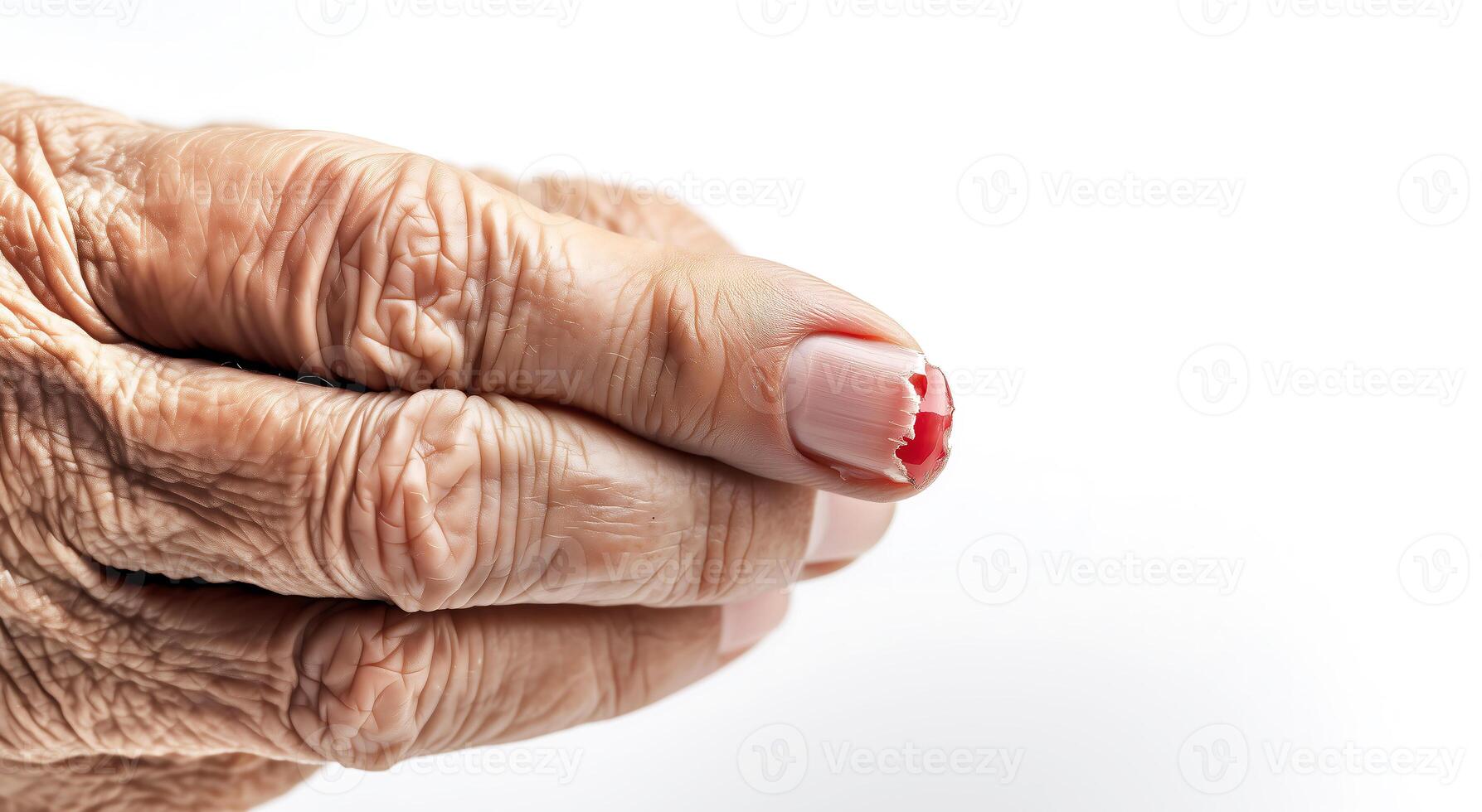 Close-Up of Elderly Hand with Broken Nail - Hand Injury, Elderly Care, Nail Damage photo