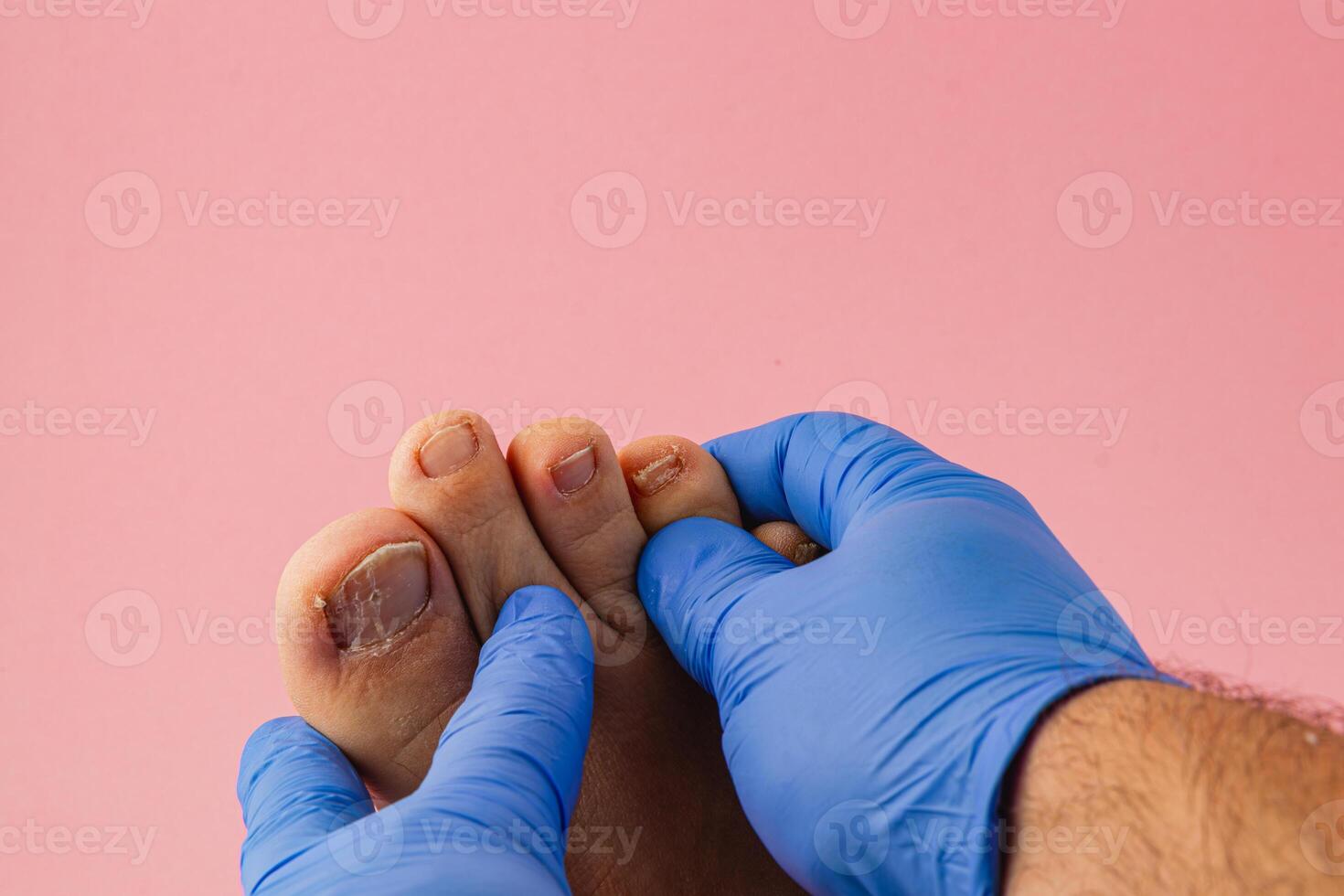Caring for foot health with professional treatment at home photo