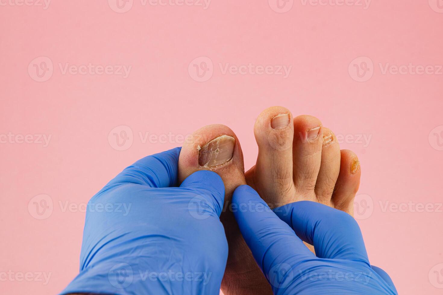 Foot care procedure with medical gloves on patients toes photo