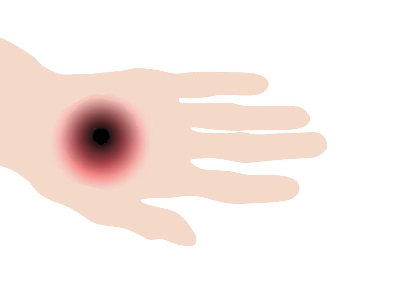 Eschar, Hand with red, cutaneous anthrax skin lesion featuring dark center vector