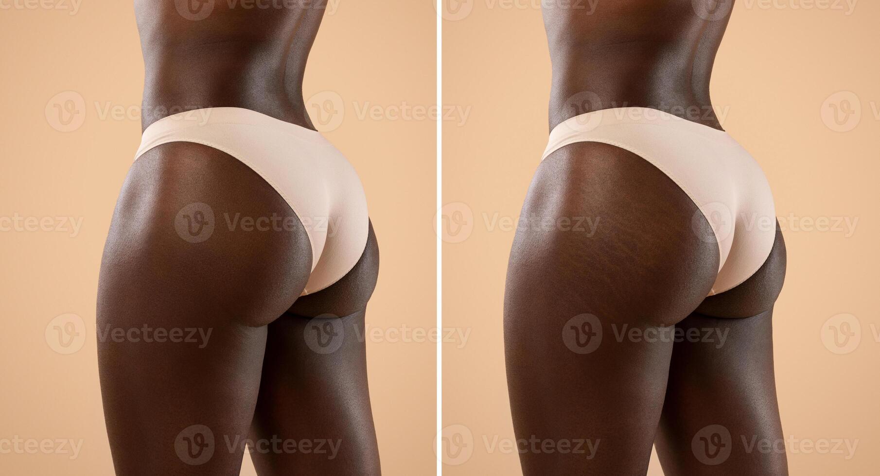 Collage for before and after massage, liposuction, soothing beauty products using results concept, unrecognizable black woman showing her buttocks with and without stretch marks, two shots, panorama photo