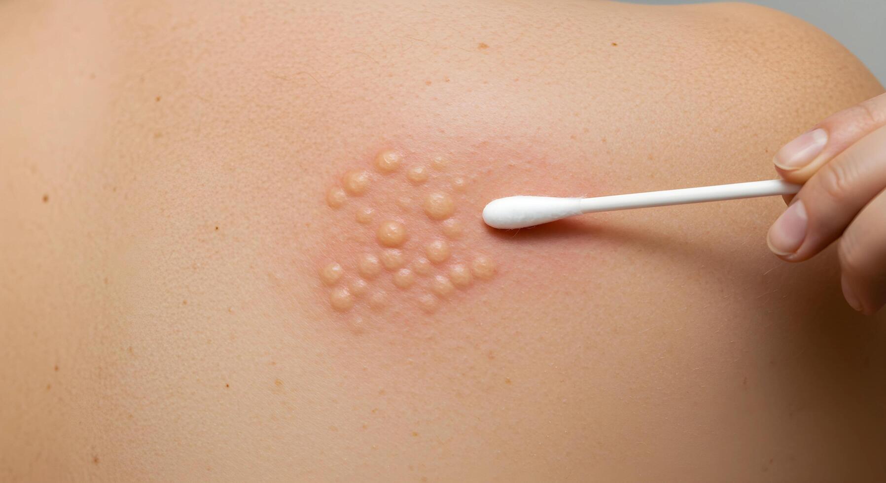 Detailed medical image of a shingles rash on the upper back, highlighting clusters of blisters and skin irritation. photo
