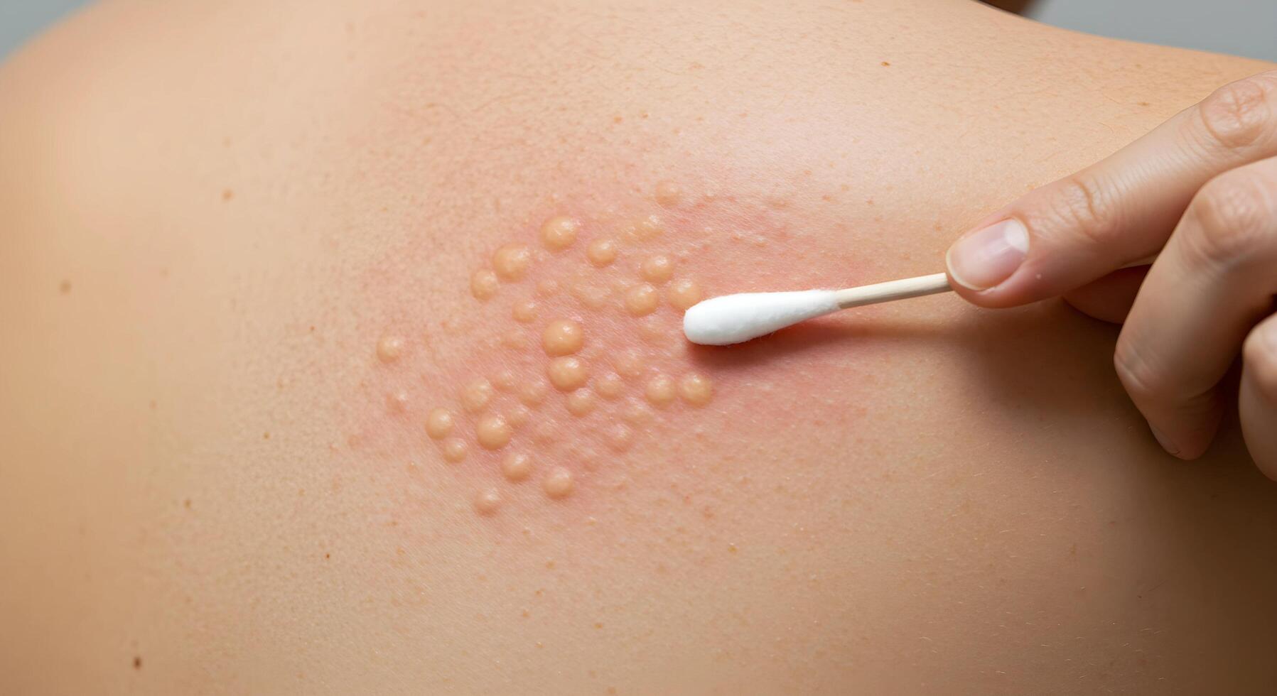 Close-up of a dermatologist treating a shingles rash on a woman back with a cotton swab. photo