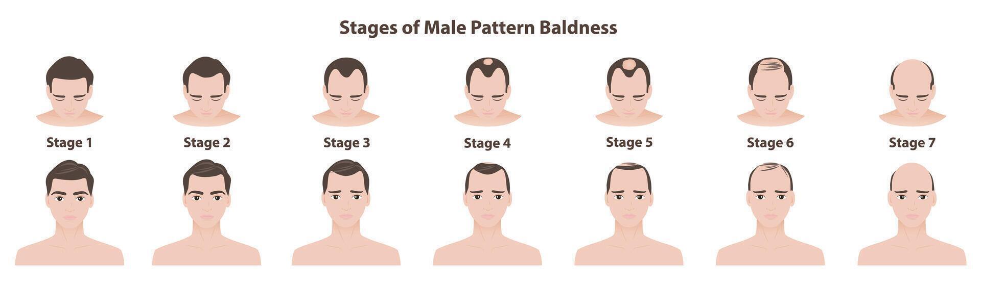 The stages of male pattern baldness illustration isolated on white background. The Norwood scale defines seven stages of male pattern hair loss or androgenetic alopecia. Hair care concept. vector
