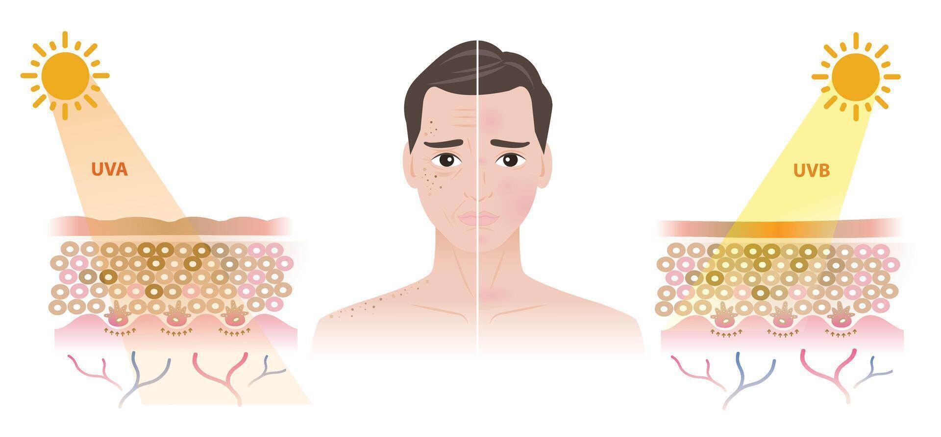Comparison of damaged man face from UVA and UVB rays illustration. UVA resulting in freckles, aging, wrinkle, dark spots. UVB resulting in a burn, inflammation, red spots. Men skin care concept. vector