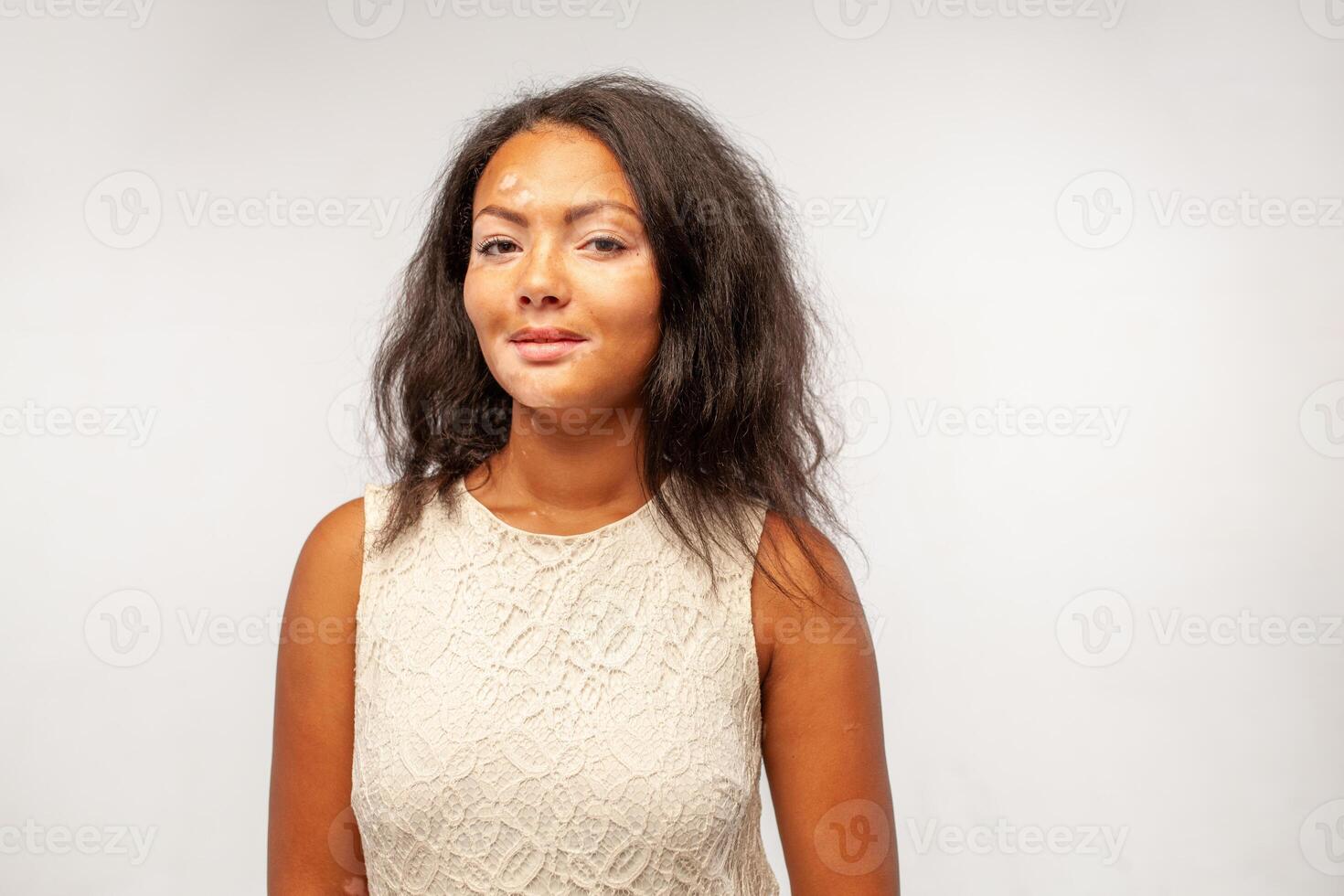 Portrait of young woman with vitiligo smiling at camera photo