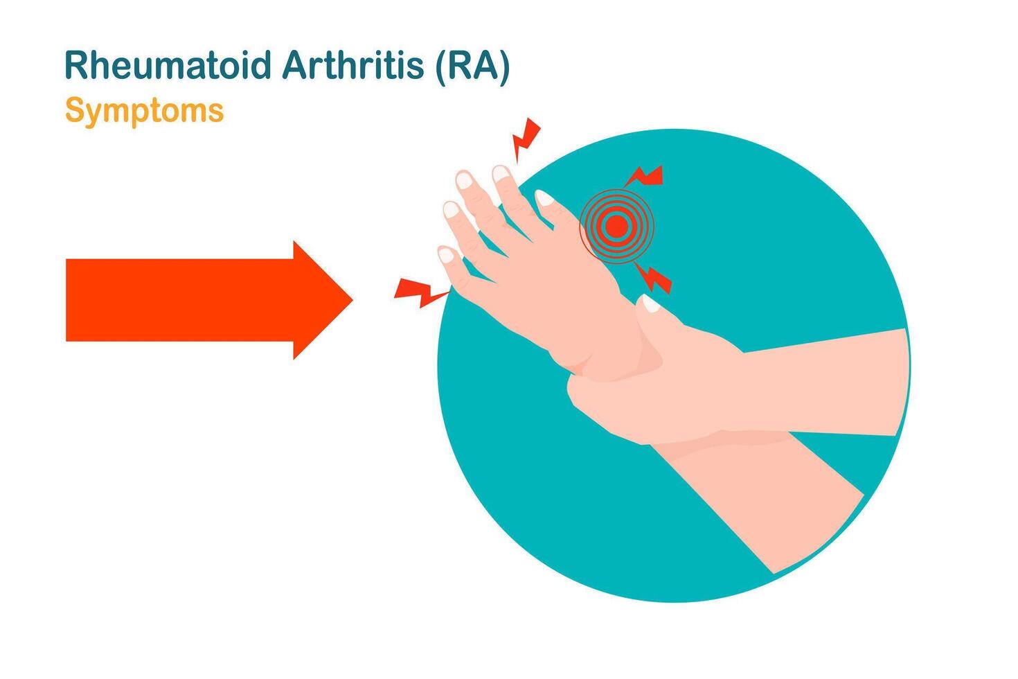 Illustration of a hand with rheumatoid arthritis. Flat medical illustration vector