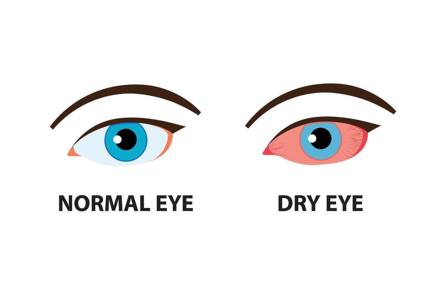 Comparison illustration between normal and dry eye. vector