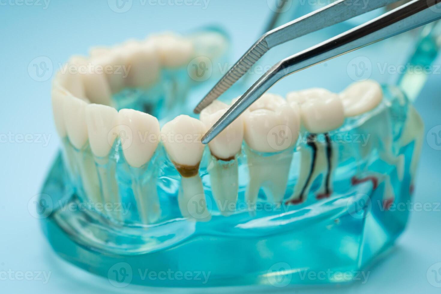 Dental teeth model treatment photo