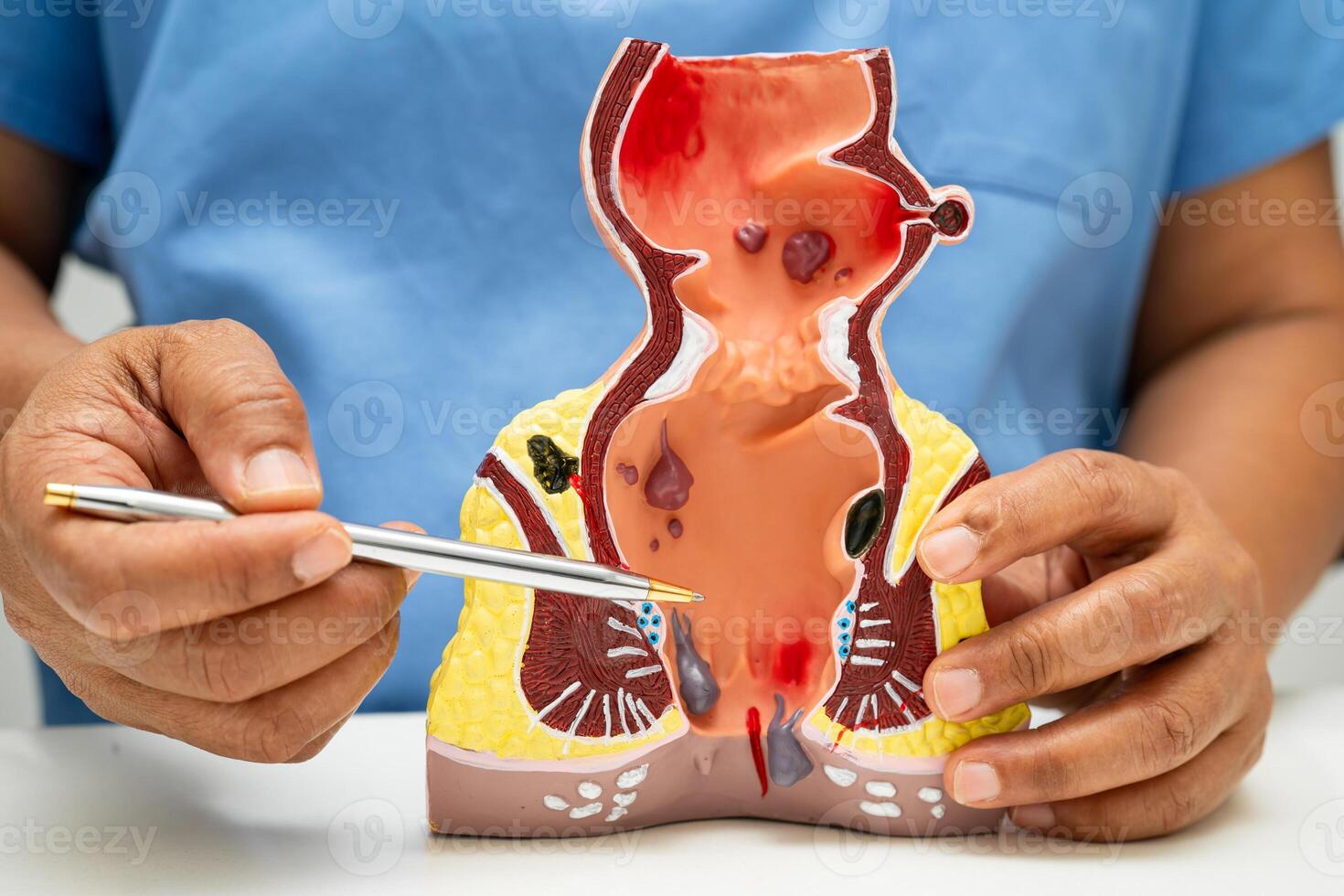 doctor with rectum and hemorrhoid human anatomy model at hospital, inflamed vascular structure. photo