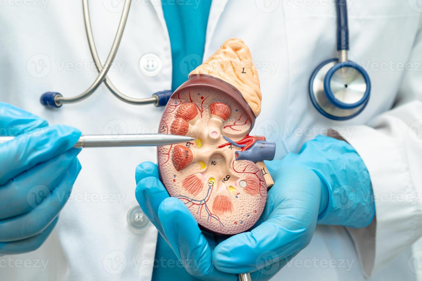 Kidney disease, Chronic photo