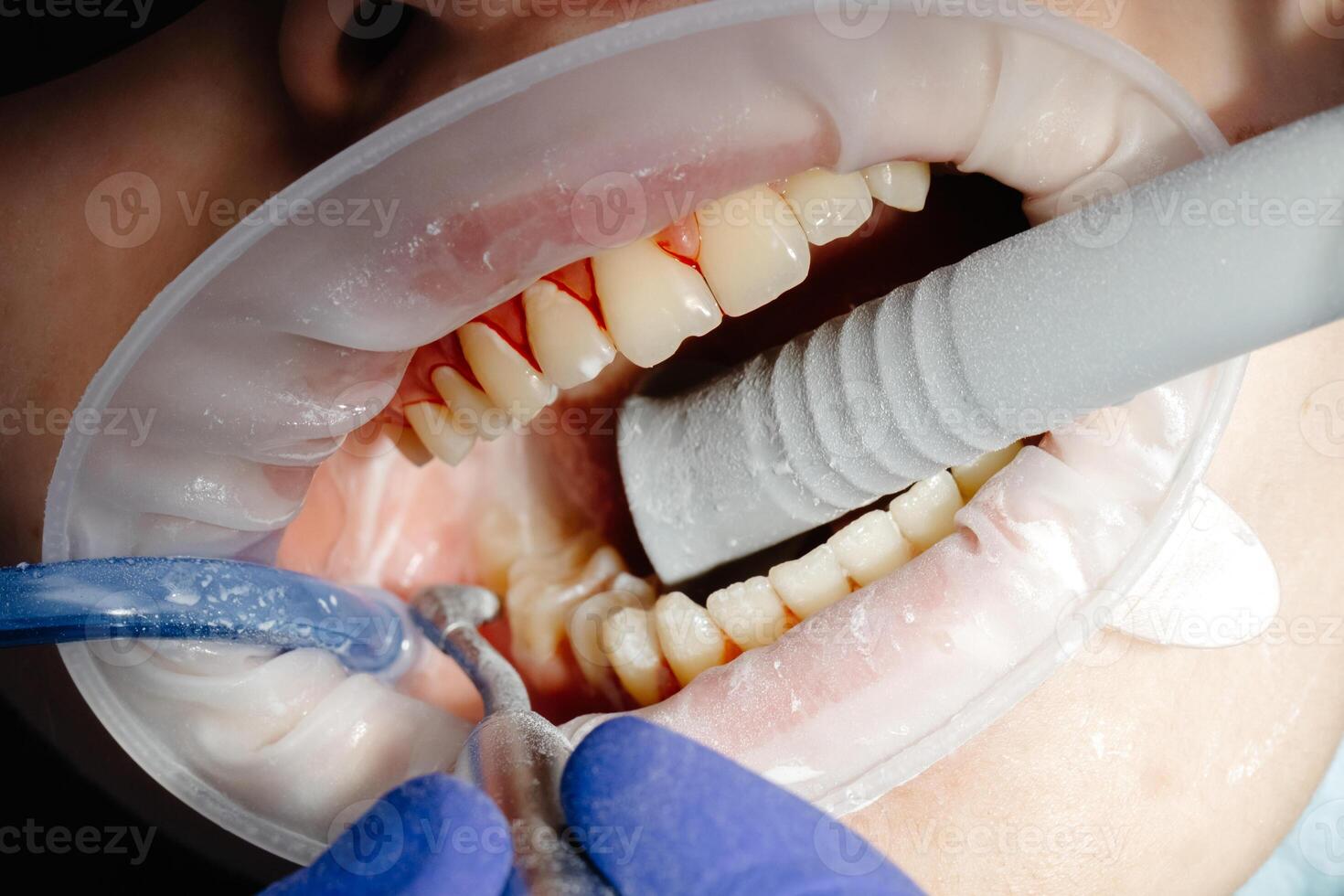 Dentist performing dental checkup cleaning teeth of patient photo