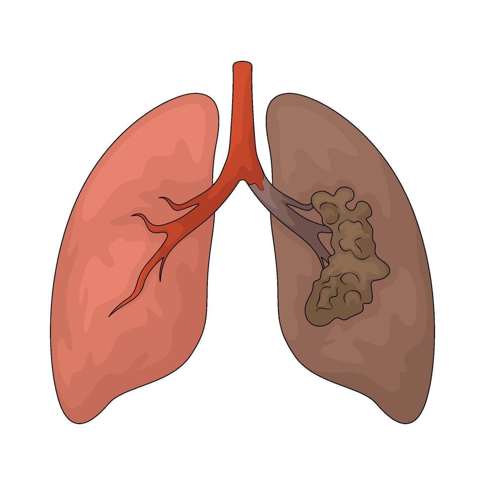 lung cancer due to smoking vector