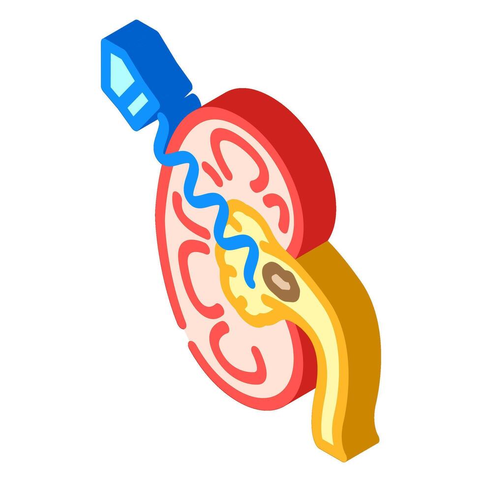 lithotripsy urology isometric icon illustration vector