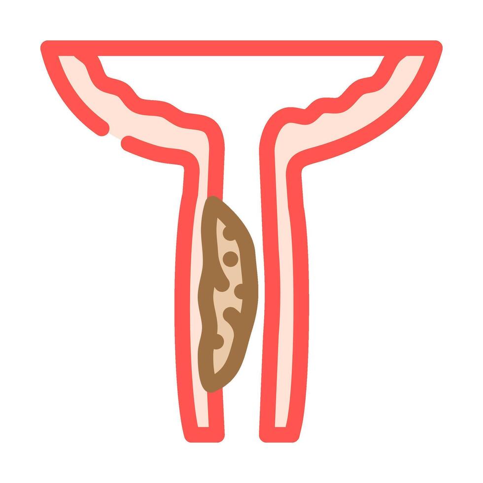 urethral stricture urology color icon illustration vector