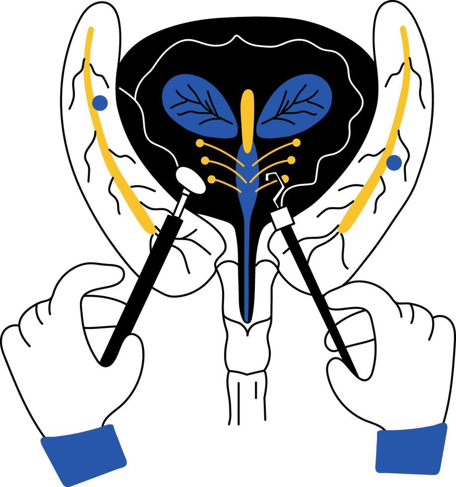 A doodle style illustration showing bladder surgery vector