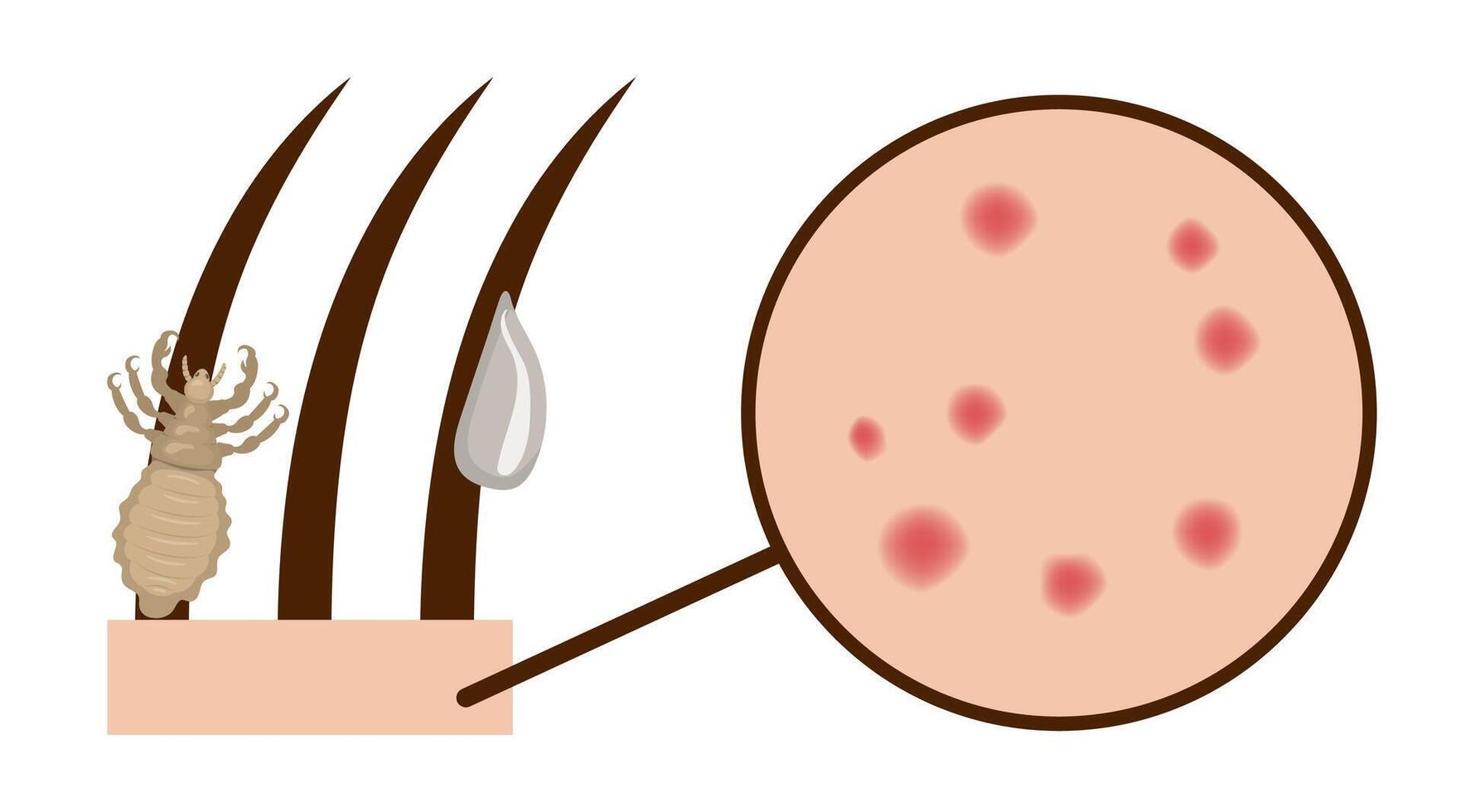 Pimple Cheek Vector Art Icons and Graphics for Free Download Pimple Cheek Vector Art Icons and Graphics for Free Download