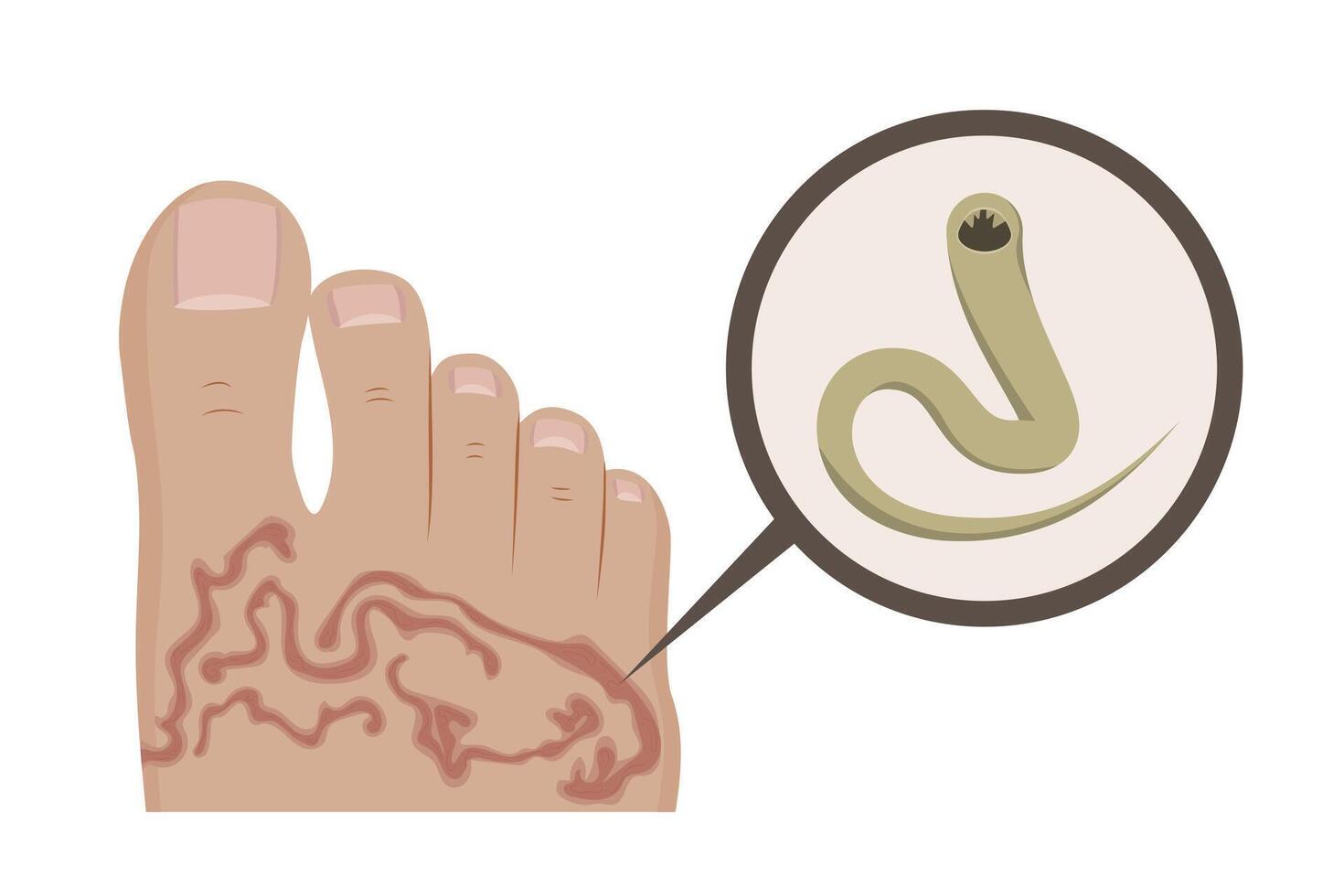 Hookworm causing cutaneous larva migrans infection in human foot vector