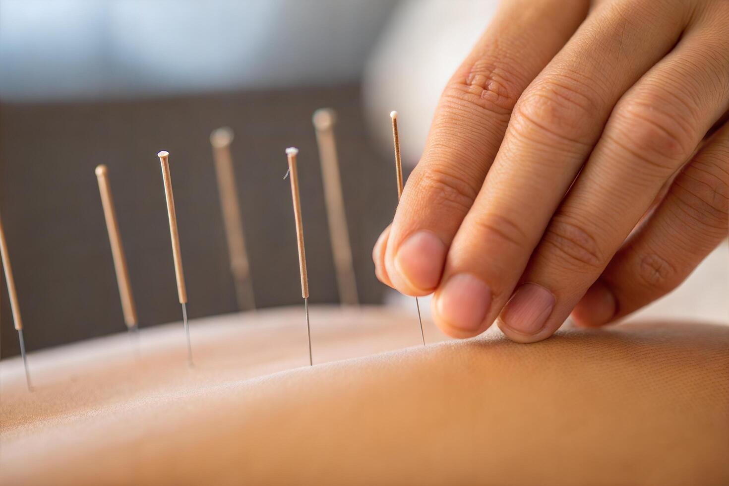 Asian hand inserts acupuncture needles into soft skin to promote healing and wellness photo