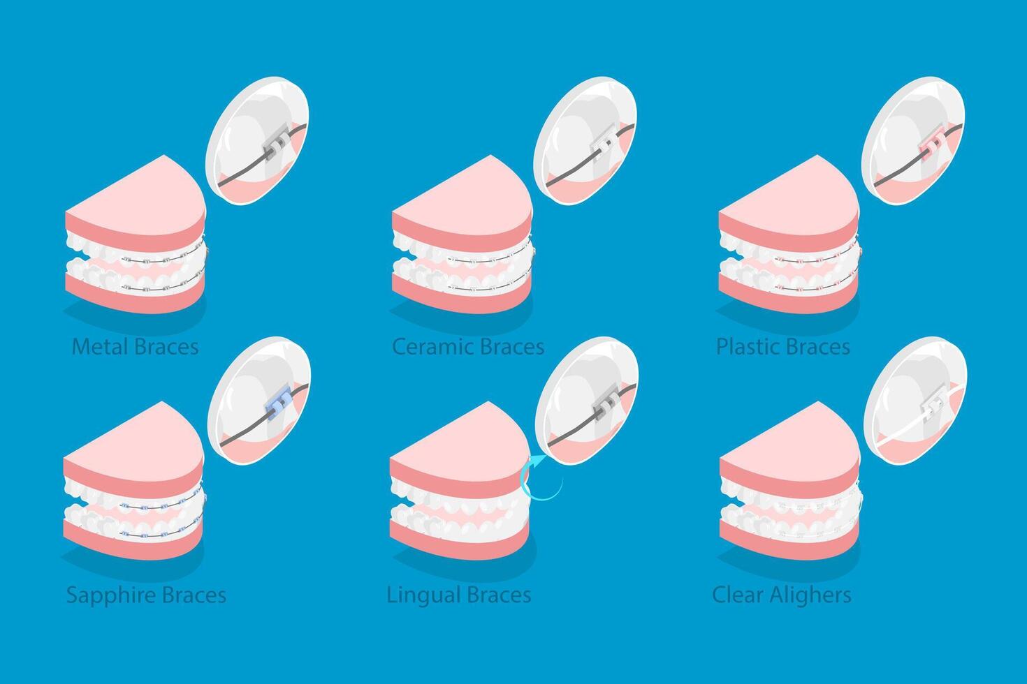 3D Isometric Flat Illustration of Dental Teeth Braces Types, Orthodontic Options for Teeth Straightening vector