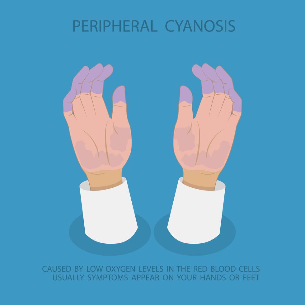 3D Isometric Flat Illustration of Peripheral Cyanosis Symptoms, Low Oxygen Levels in Extremities vector