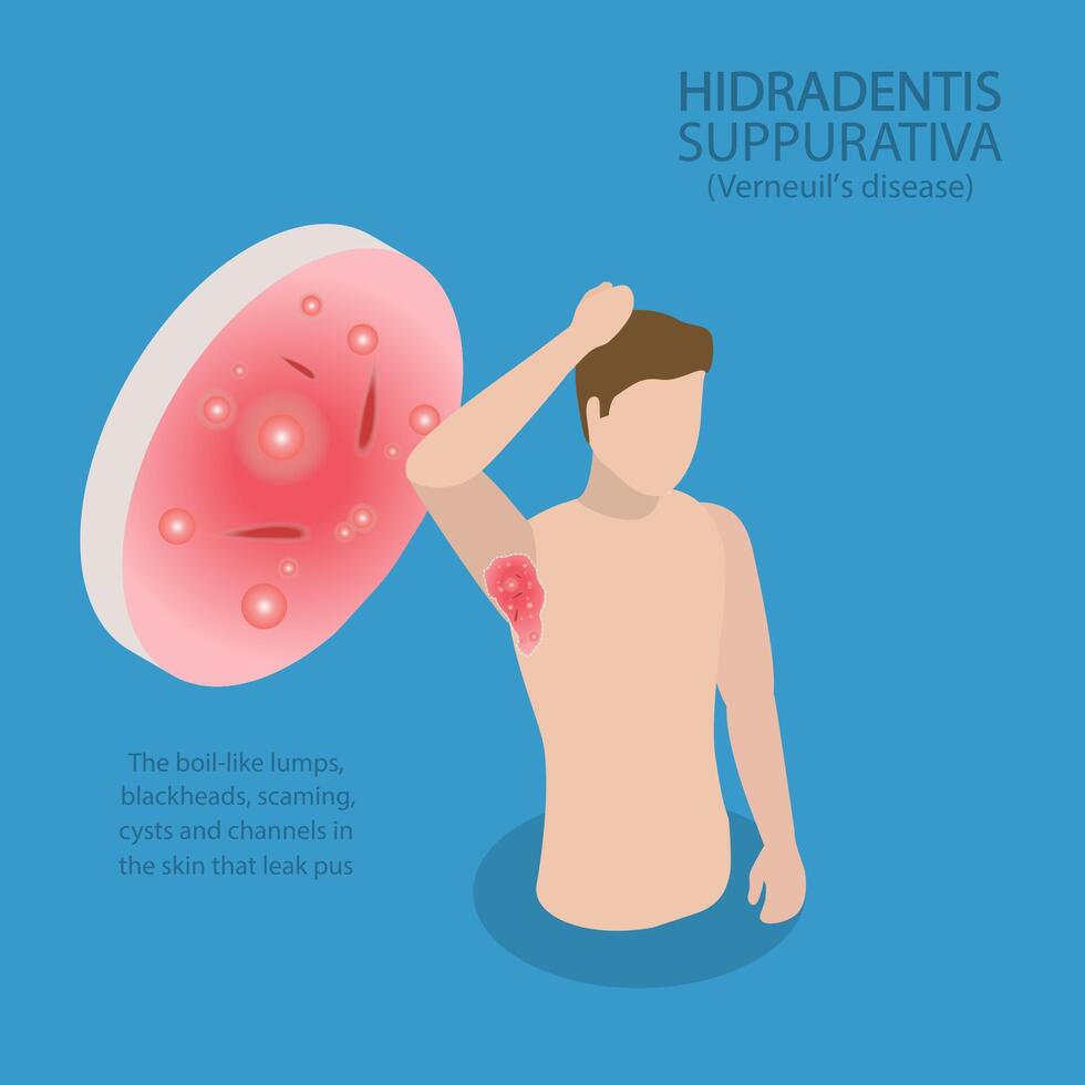 3D Isometric Flat Illustration of Hidradenitis Suppurativa, Painful Lumps Under the Skin vector